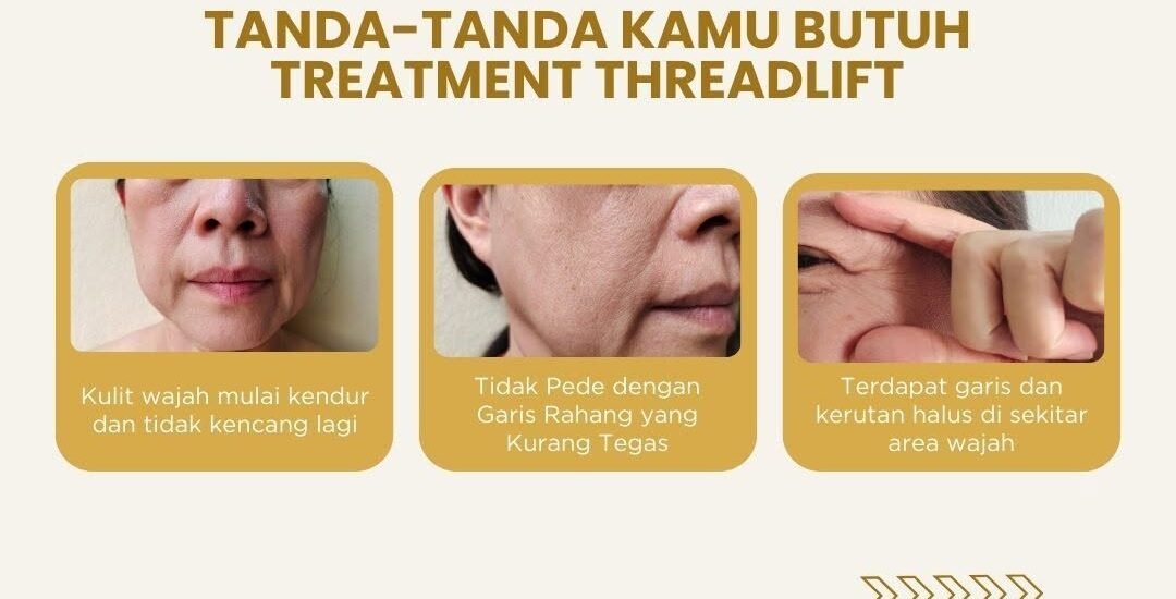 threadlift