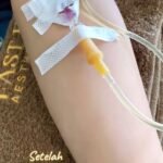 infus whitening jember